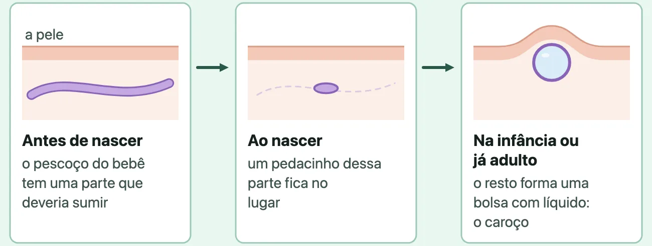 Esquema em três quadros da pele e do que fica embaixo dela: antes de nascer, uma faixa comprida sob a pele do pescoço do bebê; ao nascer, a faixa sumiu e sobrou um pedacinho; na infância ou já adulto, no lugar do pedacinho, uma bolsa redonda com líquido levanta a pele e forma o caroço.