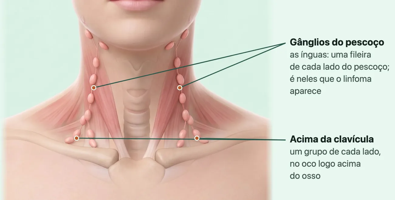 Ilustração do pescoço de frente, com a pele translúcida, mostrando dos dois lados uma fileira de pequenos gânglios rosados ao longo do pescoço e um grupo de gânglios logo acima de cada clavícula.