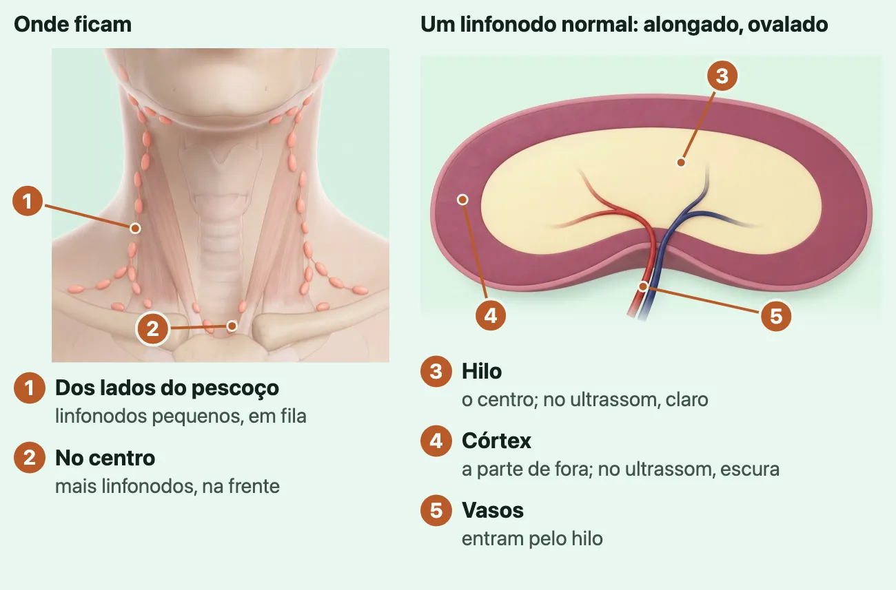 Dois desenhos. No primeiro, a frente do pescoço, do queixo às clavículas, com a pele transparente: pequenos linfonodos ovais cor de coral em fila dos dois lados do pescoço, da mandíbula até acima da clavícula, e alguns no centro, logo acima do esterno. No segundo, um linfonodo normal, alongado e ovalado, aberto ao comprido: a borda, o córtex, em rosa-escuro; o centro, o hilo, claro; uma pequena artéria e uma pequena veia entram pela reentrância da borda de baixo até o centro.