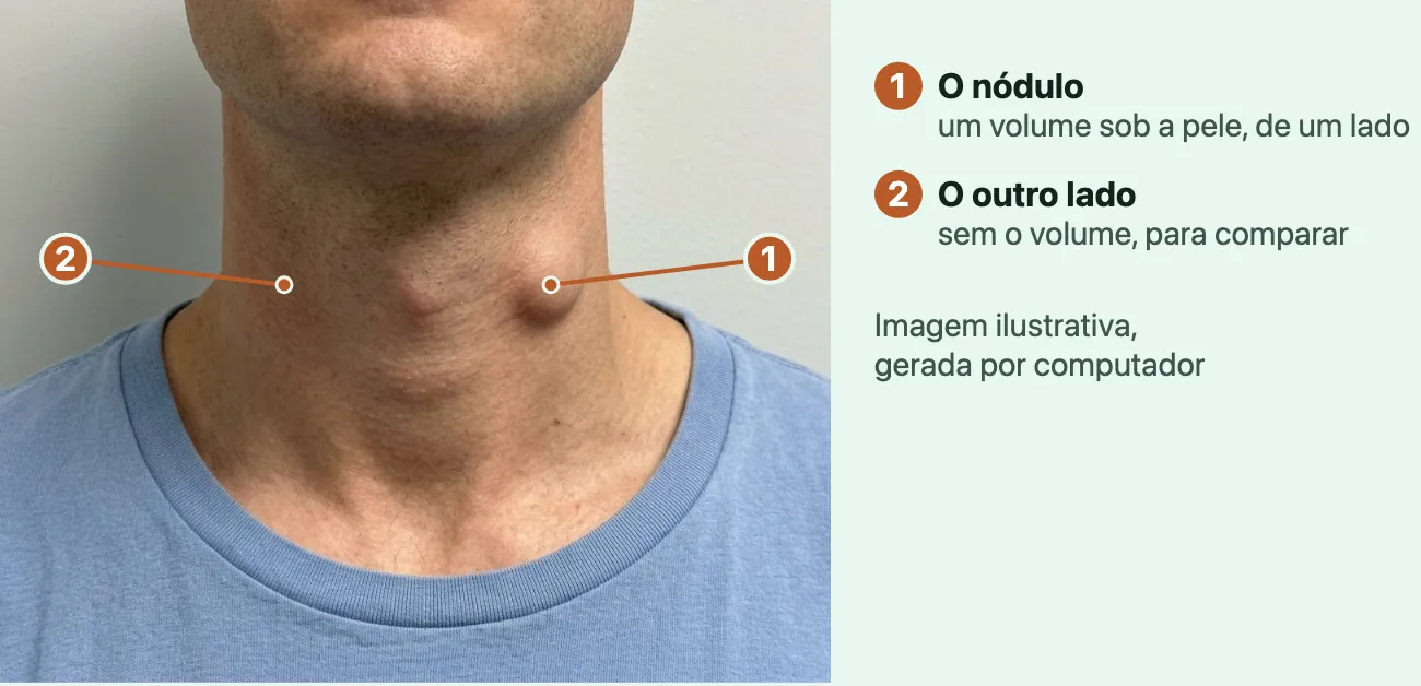 Imagem gerada por computador, com aspecto de foto, da frente do pescoço de um homem adulto, do queixo à gola de uma camiseta azul-clara, sem os olhos: de um lado do pescoço, um volume arredondado levanta a pele, que tem a cor normal por cima; o outro lado, na mesma altura, é liso.