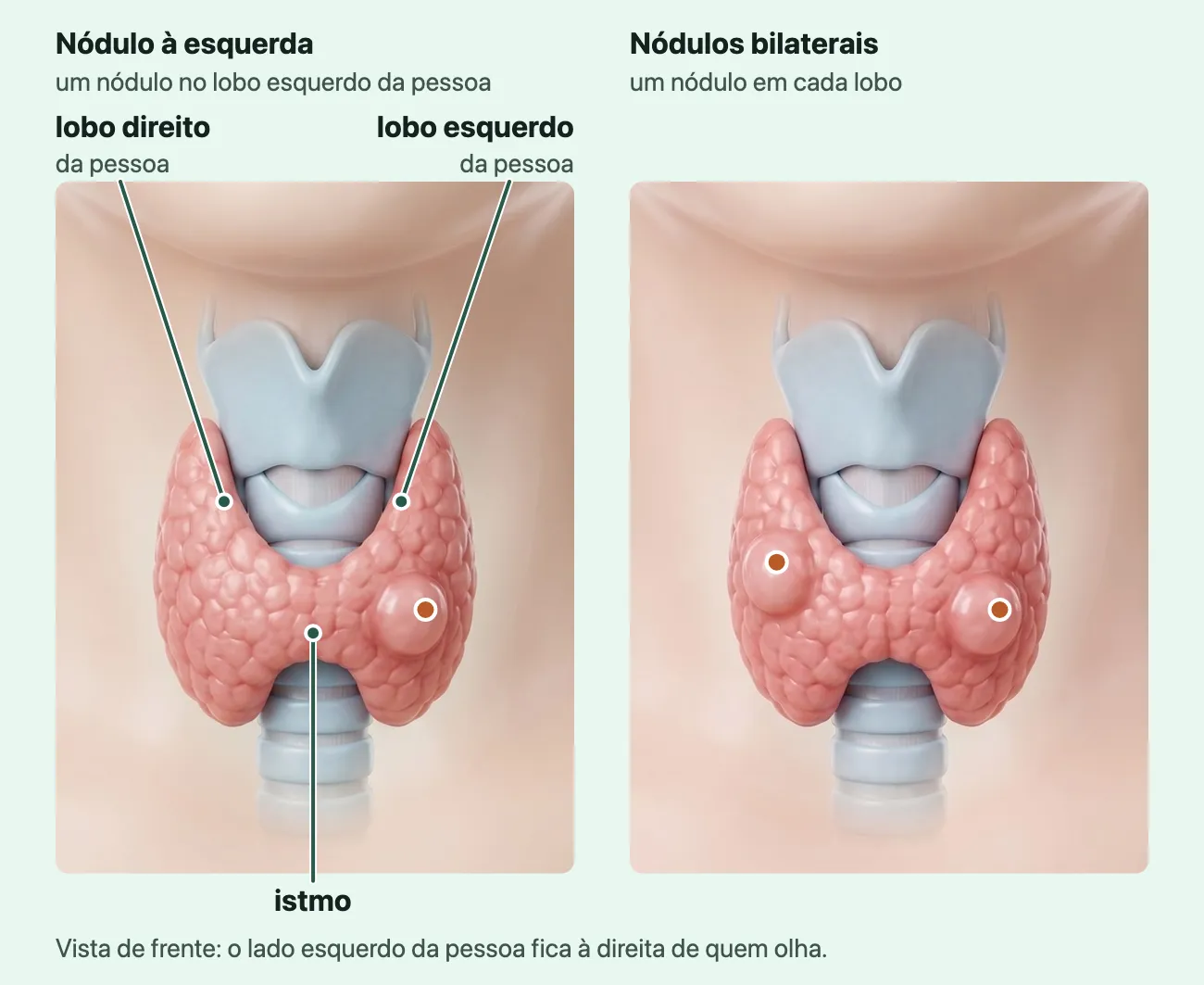 Dois desenhos da tireoide vista de frente no pescoço, abaixo do pomo de adão e na frente da traqueia: no primeiro, nódulo tireoidiano à esquerda, no lobo esquerdo da pessoa, que aparece à direita de quem olha, com os rótulos lobo direito, lobo esquerdo e istmo; no segundo, nódulos bilaterais, um em cada lobo.