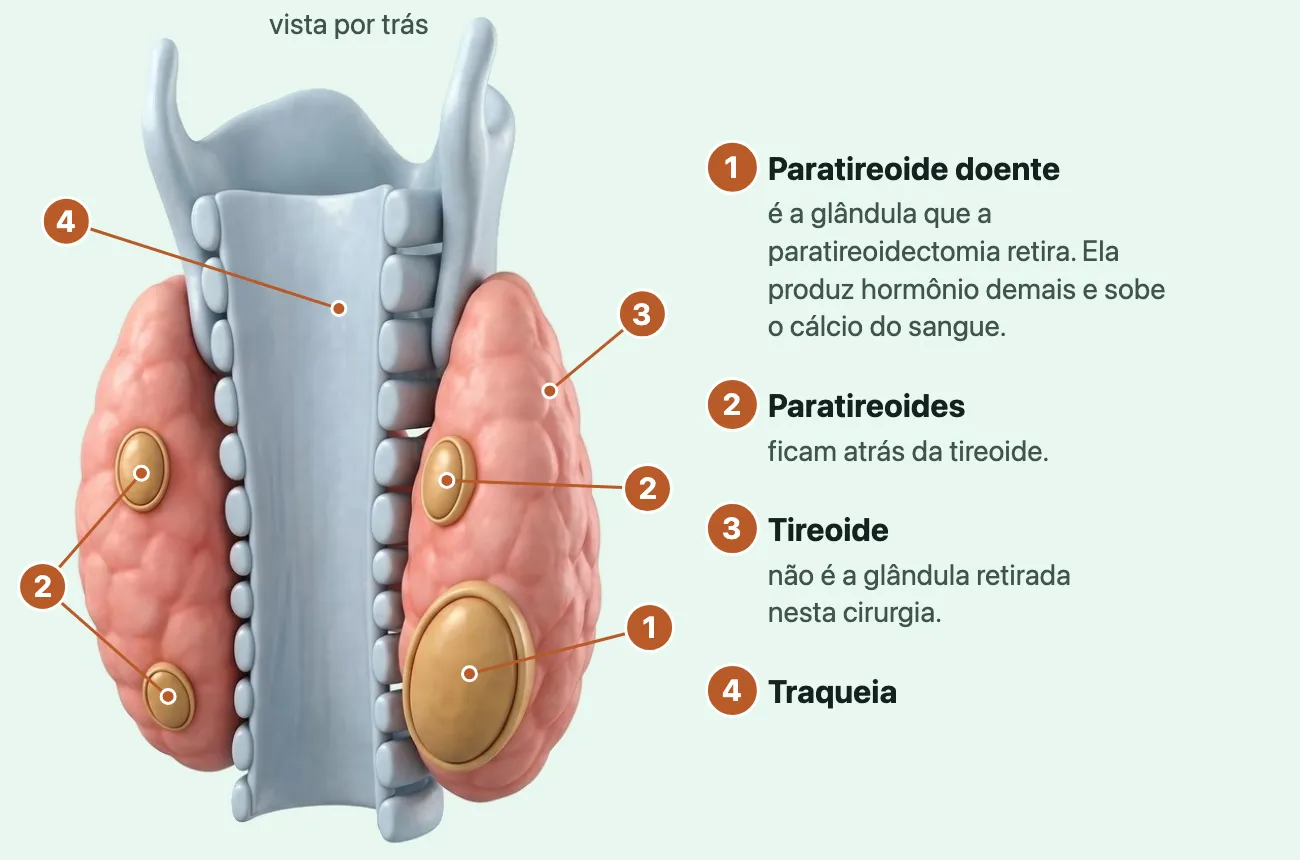 Ilustração da laringe, da traqueia e da tireoide vistas por trás: sobre os dois lobos rosados da tireoide, quatro pequenas glândulas douradas, as paratireoides, duas de cada lado; a de baixo de um dos lados está bem maior que as outras, a paratireoide doente.