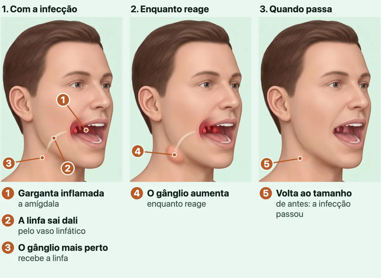 Três desenhos da mesma cabeça de três quartos, de boca aberta. No primeiro, as amígdalas vermelhas no fundo da garganta e um vaso claro que sai de trás da boca, passa sob a pele da bochecha e desce até um gânglio pequeno, do tamanho de uma ervilha, visto de leve sob a pele logo abaixo do ângulo da mandíbula; no segundo, o mesmo gânglio aumentado, do tamanho de uma uva, levantando um pouco a pele do pescoço; no terceiro, a garganta calma, rosa-clara, e o gânglio de novo pequeno.