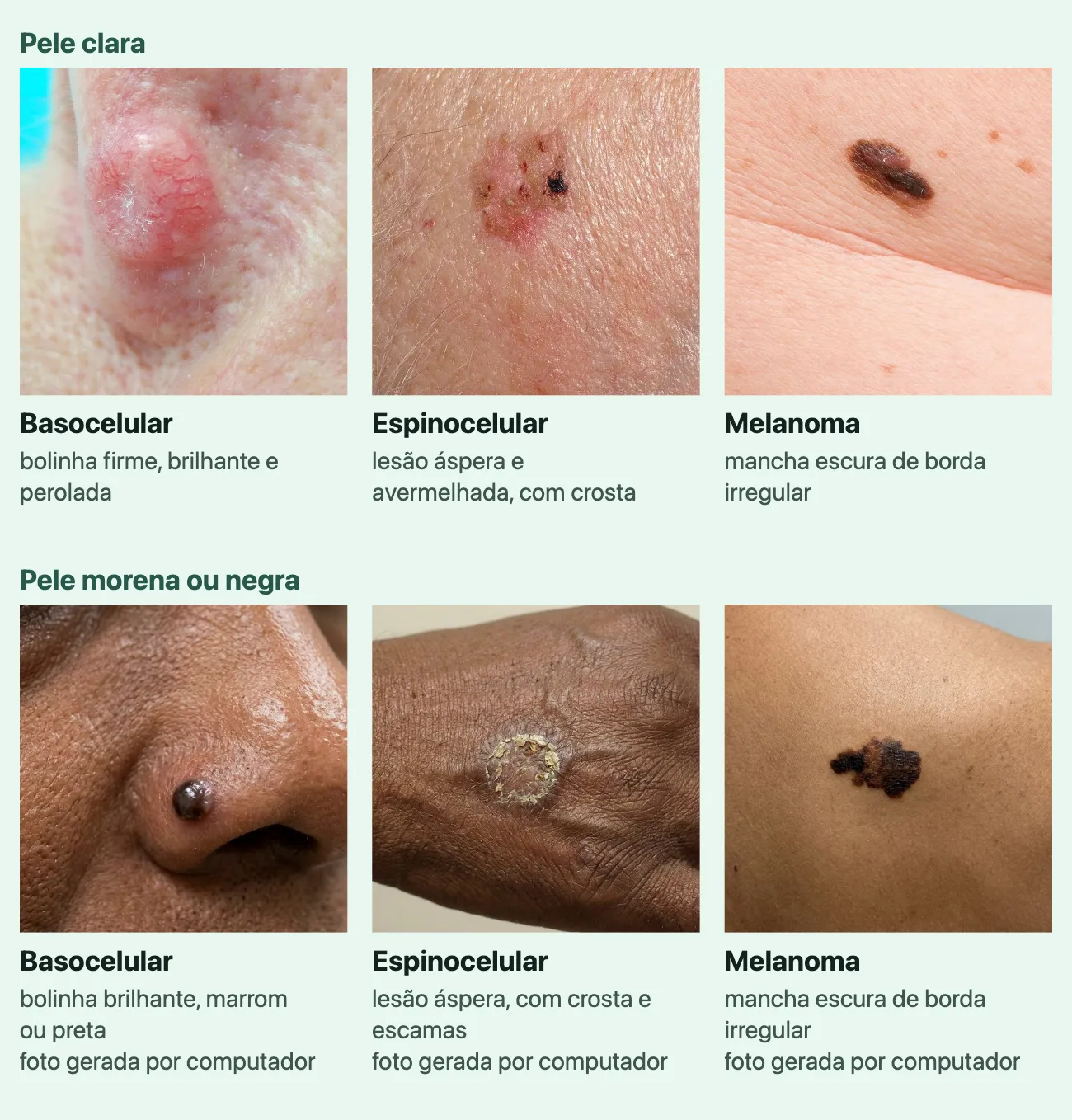 Seis fotos de lesões de pele, cada uma com o nome do tipo e uma linha. Em "Pele clara": "Basocelular", "bolinha firme, brilhante e perolada", um caroço rosado e brilhante, com vasinhos finos na superfície, junto ao nariz; "Espinocelular", "lesão áspera e avermelhada, com crosta", uma placa avermelhada que descama, com um ponto de crosta escura, na pele enrugada; "Melanoma", "mancha escura de borda irregular", uma mancha marrom-escura e alongada entre sardas pequenas. Em "Pele morena ou negra", três fotos marcadas "foto gerada por computador": "Basocelular", "bolinha brilhante, marrom ou preta", uma bolinha escura e lisa na asa do nariz; "Espinocelular", "lesão áspera, com crosta e escamas", uma placa redonda com crosta amarelada no dorso da mão; "Melanoma", "mancha escura de borda irregular", uma mancha preta e marrom de contorno recortado na pele morena.