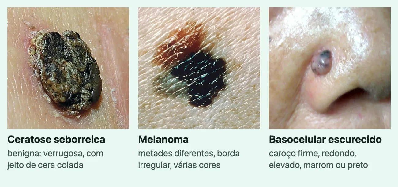 Três fotos de lesões escuras, cada uma com o nome e uma linha. "Ceratose seborreica", "benigna: verrugosa, com jeito de cera colada": uma lesão marrom-escura, grossa e rugosa, que parece colada sobre a pele. "Melanoma", "metades diferentes, borda irregular, várias cores": uma mancha plana, preta, marrom-avermelhada e acinzentada, de contorno irregular. "Basocelular escurecido", "caroço firme, redondo, elevado, marrom ou preto": uma bolinha redonda, elevada e arroxeada, na asa do nariz.