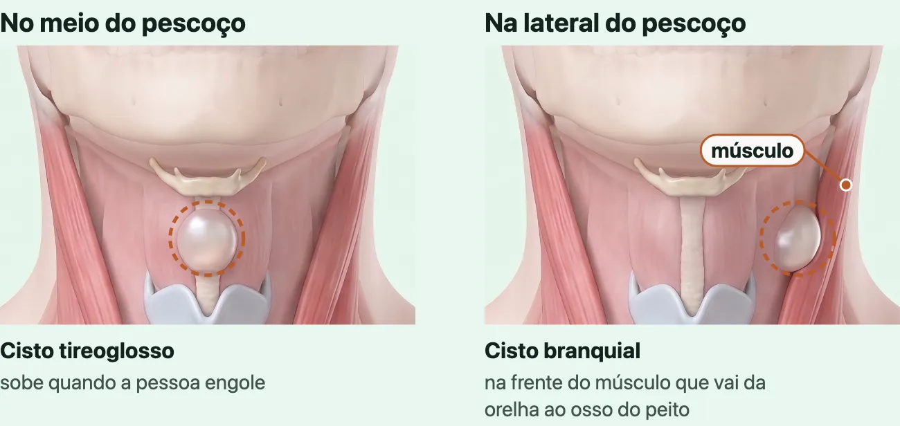 Dois desenhos do mesmo pescoço visto de frente, com a pele transparente, a mandíbula, a cartilagem do pomo de adão e o músculo de cada lado. No primeiro, um cisto redondo no meio do pescoço, logo acima do pomo de adão: o cisto tireoglosso. No segundo, um cisto redondo na lateral do pescoço, abaixo da mandíbula, junto da borda da frente do músculo: o cisto branquial.