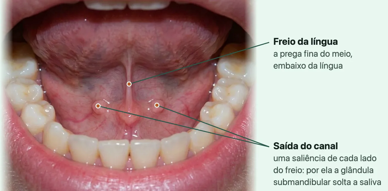 Boca aberta com a ponta da língua levantada, mostrando o freio da língua no meio e, de cada lado da base dele, atrás dos dentes da frente de baixo, uma pequena saliência rosada por onde sai a saliva da glândula submandibular.
