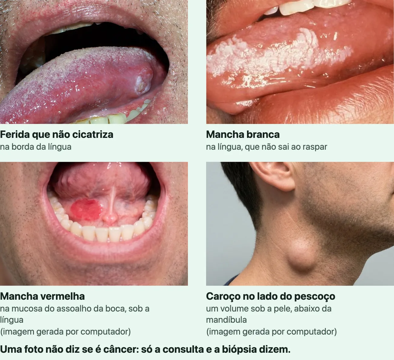 Quatro fotografias lado a lado. Uma boca aberta com a língua para fora, e na borda da língua uma pequena ferida esbranquiçada de bordas altas. Uma língua com uma mancha branca irregular na lateral. Uma boca aberta com a língua levantada, mostrando uma mancha vermelha lisa no assoalho da boca, atrás dos dentes de baixo. O lado do pescoço de um homem, com um volume arredondado sob a pele logo abaixo da mandíbula.