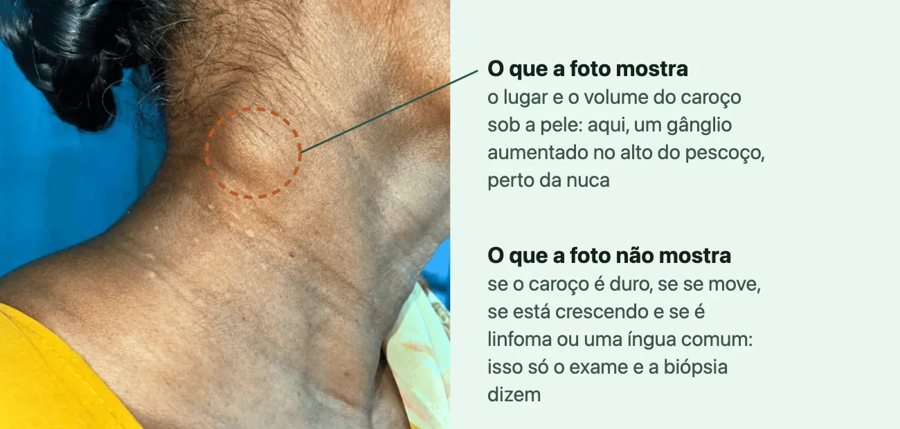 Foto do lado e de trás do pescoço de uma mulher, com a cabeça inclinada, mostrando um volume arredondado sob a pele no alto do pescoço, perto da nuca, com a pele da cor normal, marcado por um contorno tracejado.