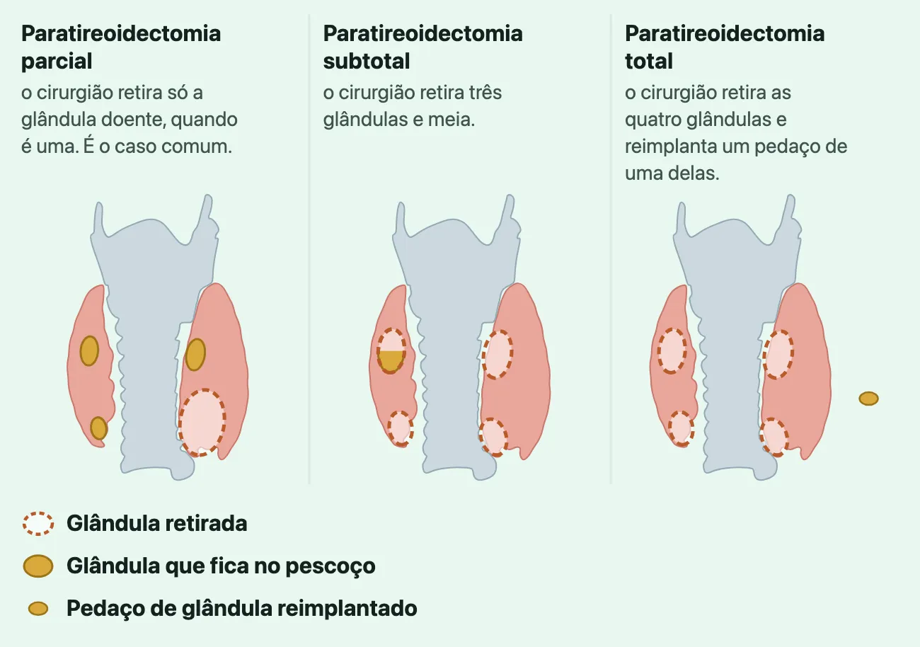 Três esquemas iguais da tireoide vista por trás, com as quatro paratireoides. Na parcial, só a glândula doente, maior, está tracejada; as outras três ficam. Na subtotal, as glândulas aumentadas estão tracejadas, menos metade de uma, que fica no pescoço. Na total, as quatro estão tracejadas, e um pequeno pedaço dourado fica ao lado do esquema, fora dele: o pedaço de glândula reimplantado.