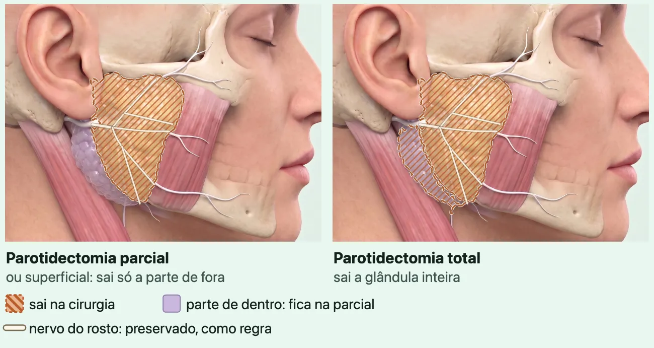 Dois desenhos iguais do lado do rosto sem a pele, com a orelha, a parótida e o nervo do rosto, em branco, entrando na glândula e se abrindo em ramos; no primeiro, só a parte de fora da glândula está hachurada como a que sai e a parte de dentro fica; no segundo, a glândula inteira está hachurada.