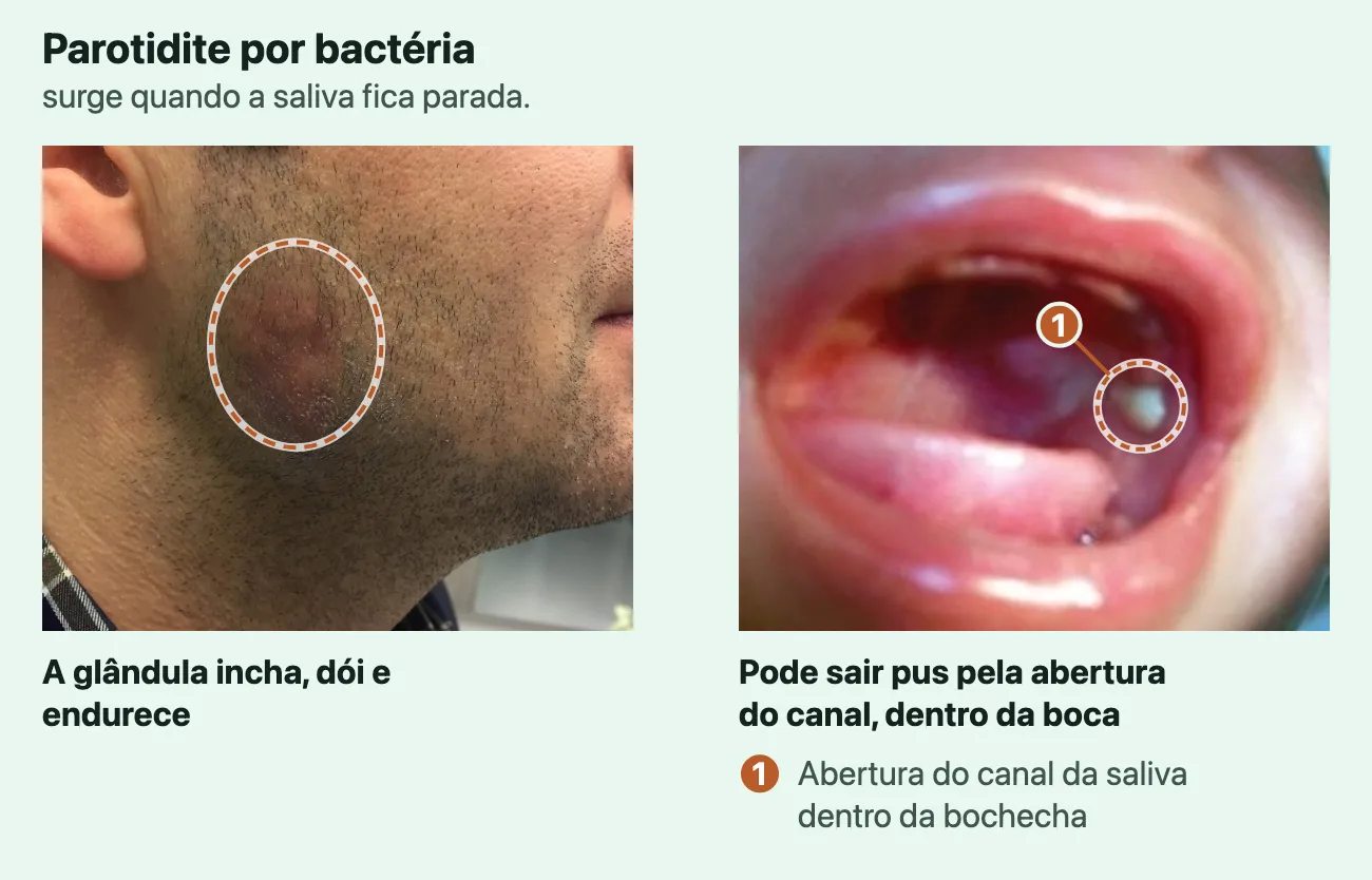 Duas fotos reais de parotidite por bactéria. Na primeira, o lado direito do rosto de um homem, de perfil, com a orelha à vista e uma área inchada e avermelhada na frente e embaixo dela, contornada. Na segunda, uma boca aberta com uma gota branco-amarelada de pus na parte de dentro da bochecha, marcada por um anel: é a abertura do canal da saliva.