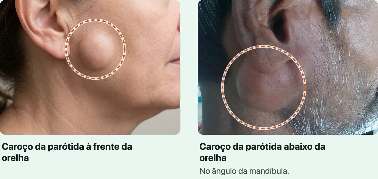 Duas fotos do lado do rosto: à esquerda, uma mulher de perfil com um caroço arredondado sob a pele logo à frente da orelha, marcado por um anel tracejado; à direita, um homem visto de lado com um caroço arredondado logo abaixo do lóbulo da orelha, sobre o ângulo da mandíbula, também marcado por um anel.