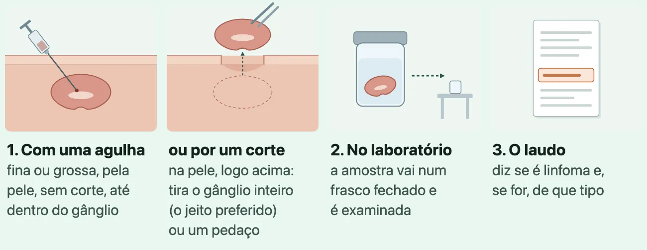 Desenho em quatro quadros: uma agulha entra pela pele até dentro de um gânglio; ou um corte na pele por onde o gânglio inteiro é retirado com uma pinça; o gânglio num frasco fechado a caminho do laboratório; e a folha do laudo com uma linha destacada.