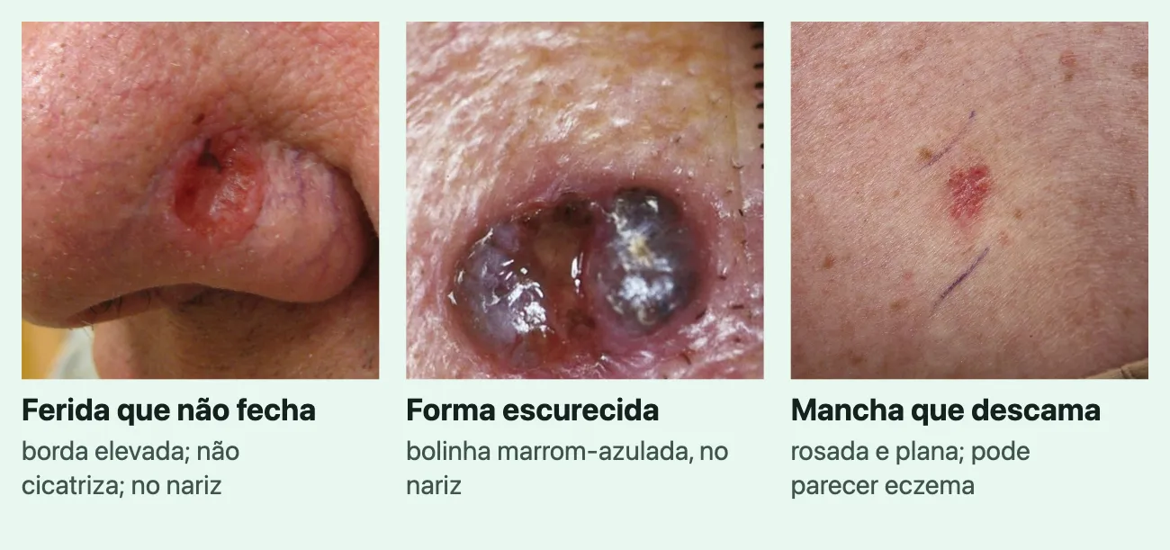 Três fotos do carcinoma basocelular, cada uma com o nome e uma linha. "Ferida que não fecha", "borda elevada; não cicatriza; no nariz": uma ferida rasa e avermelhada, de borda elevada, na asa do nariz. "Forma escurecida", "bolinha marrom-azulada, no nariz": uma lesão elevada, com partes marrom-azuladas e brilhantes. "Mancha que descama", "rosada e plana; pode parecer eczema": uma mancha pequena, rosada e plana, na pele clara com sardas.