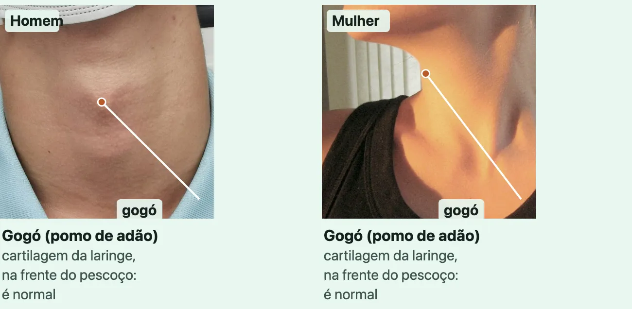 Duas fotos da frente do pescoço de adultos sem doença, sem os olhos, cada uma com um ponto sobre o gogó ligado ao rótulo "Gogó (pomo de adão)", "cartilagem da laringe, na frente do pescoço: é normal". "Homem": o pescoço de um homem visto de frente, com o ponto sobre a saliência no meio da frente do pescoço. "Mulher": o pescoço de uma mulher, um pouco de lado e com o queixo erguido, com o ponto no lugar do gogó, no alto da frente do pescoço, logo abaixo do queixo.