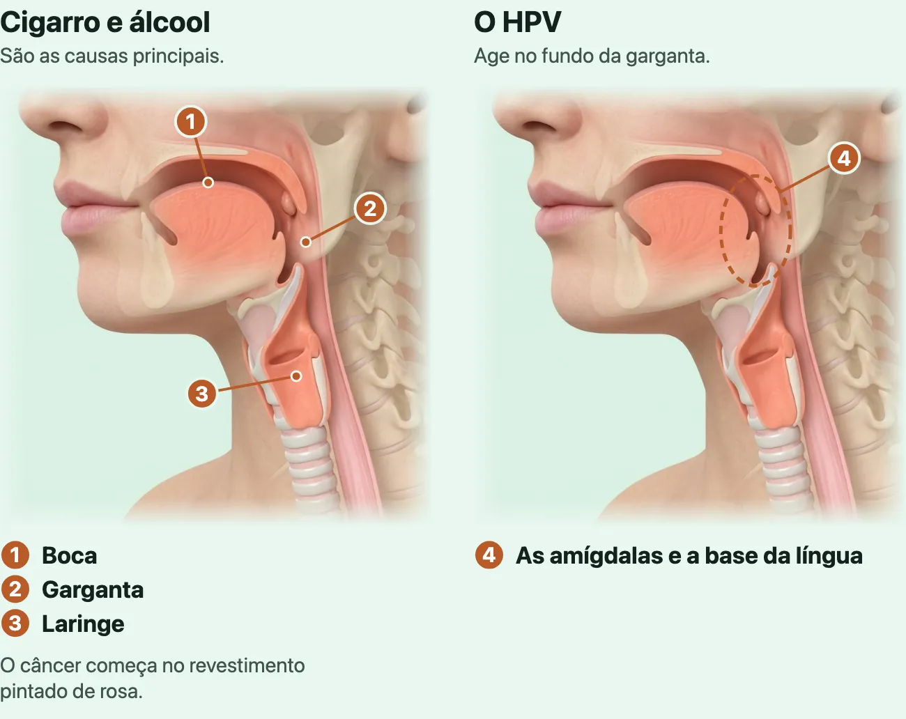 Dois desenhos da mesma cabeça de mulher de perfil, do nariz à base do pescoço, com a pele transparente e o revestimento rosado por dentro da boca, da garganta e da laringe à vista. No primeiro, sob o título "Cigarro e álcool: são as causas principais", três pontos marcam o revestimento da boca, da garganta e da laringe. No segundo, sob o título "O HPV: age no fundo da garganta", um anel tracejado envolve a amígdala e a base da língua.