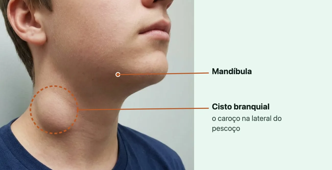 Foto do lado direito do pescoço de um adolescente, do nariz para baixo, com a orelha no alto: abaixo do ângulo da mandíbula, um caroço arredondado e liso sob a pele, marcado por um círculo tracejado, como aparece um cisto branquial.