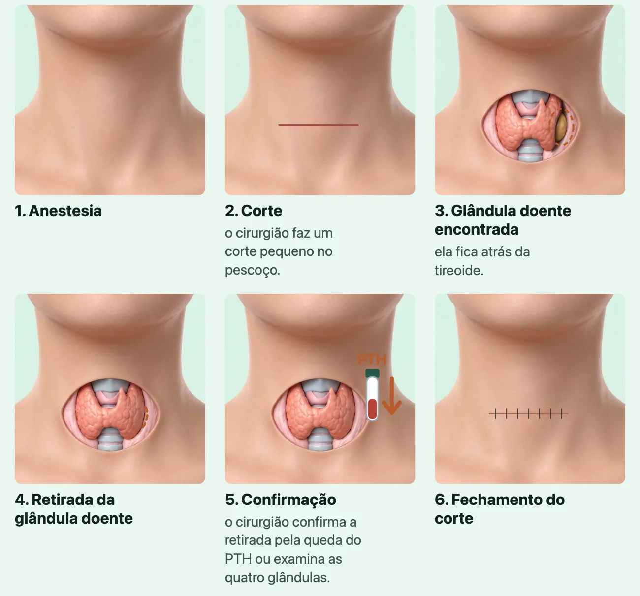 Seis ilustrações numeradas do mesmo pescoço visto de frente: a pele inteira na anestesia; uma linha curta e horizontal na parte baixa do pescoço, o corte; pela abertura, a tireoide e, meio escondida atrás da borda de um dos lobos, a glândula doente, dourada, marcada por um círculo; o lugar dela, ao lado da borda do lobo, vazio depois da retirada; um tubo de sangue com PTH e uma seta para baixo, a confirmação; o corte fechado com pontos.