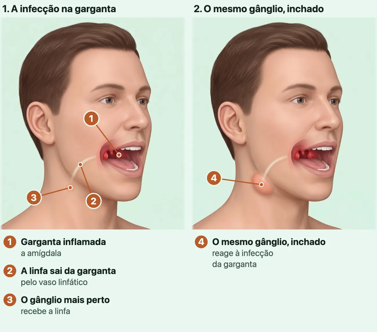 Dois desenhos da mesma cabeça de três quartos, de boca aberta: no primeiro, as amígdalas vermelhas no fundo da garganta e um vaso claro que sai de trás da boca, passa sob a pele da bochecha e desce até um gânglio pequeno, do tamanho de uma ervilha, visto de leve sob a pele logo abaixo do ângulo da mandíbula; no segundo, o mesmo gânglio inchado, do tamanho de uma uva, levantando um pouco a pele do pescoço.