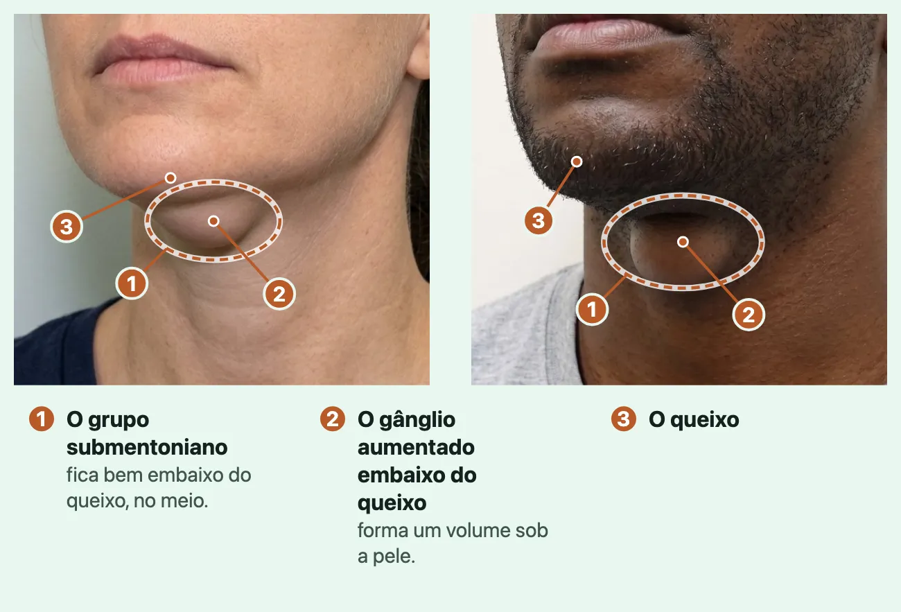Duas fotos geradas do queixo e da frente do pescoço, do lábio para baixo: uma mulher de pele clara e um homem de pele marrom escura. Nas duas, bem embaixo do queixo, no meio, um volume arredondado sob a pele de cor normal, cercado por uma linha tracejada que marca o lugar do grupo submentoniano.