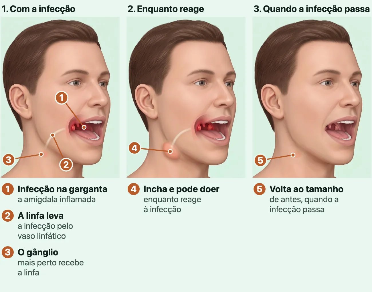 Três imagens geradas por computador da mesma cabeça de homem, de três quartos e de boca aberta. Na primeira, as amígdalas vermelhas no fundo da garganta e um vaso claro que sai de trás da boca, passa sob a pele da bochecha e desce até um gânglio pequeno, visto de leve sob a pele logo abaixo do ângulo da mandíbula; na segunda, o mesmo gânglio aumentado, levantando um pouco a pele do pescoço; na terceira, a garganta calma, rosa-clara, e o gânglio de novo pequeno.