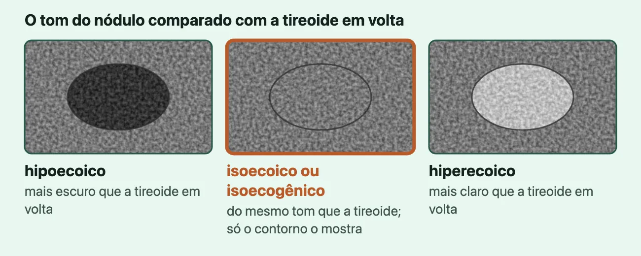 Três nódulos iguais desenhados dentro do tecido cinza da tireoide: o hipoecoico mais escuro, o isoecoico ou isoecogênico do mesmo tom, em destaque, visto só pelo contorno, e o hiperecoico mais claro.