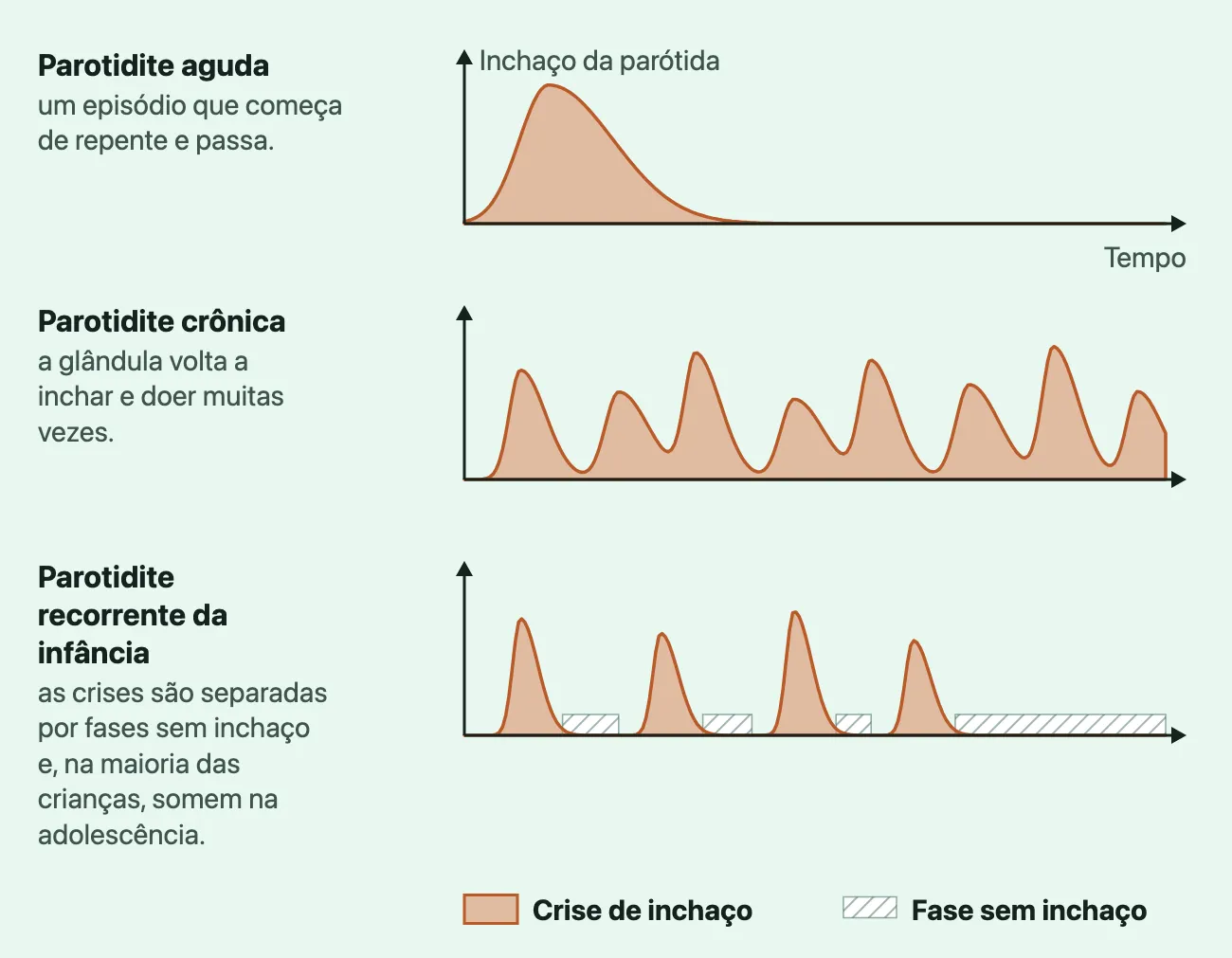 Três linhas do tempo, uma embaixo da outra, com o inchaço da parótida no eixo vertical e o tempo correndo para a direita. Na parotidite aguda, uma só crise: o inchaço sobe depressa, desce e não volta. Na crônica, crises de inchaço que voltam muitas vezes até o fim da linha. Na recorrente da infância, quatro crises separadas por fases sem inchaço, marcadas com listras, e depois a linha fica sem inchaço até o fim.