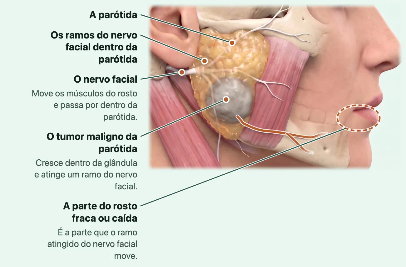 Ilustração do lado direito do rosto, sem a pele sobre a bochecha: o nervo facial, branco, entra na parótida amarela logo abaixo da orelha e se abre em ramos dentro dela; um tumor cinza no terço de baixo da glândula envolve o ramo de baixo, realçado em laranja, que segue ao longo da mandíbula; um anel tracejado marca o canto da boca e o lábio de baixo.