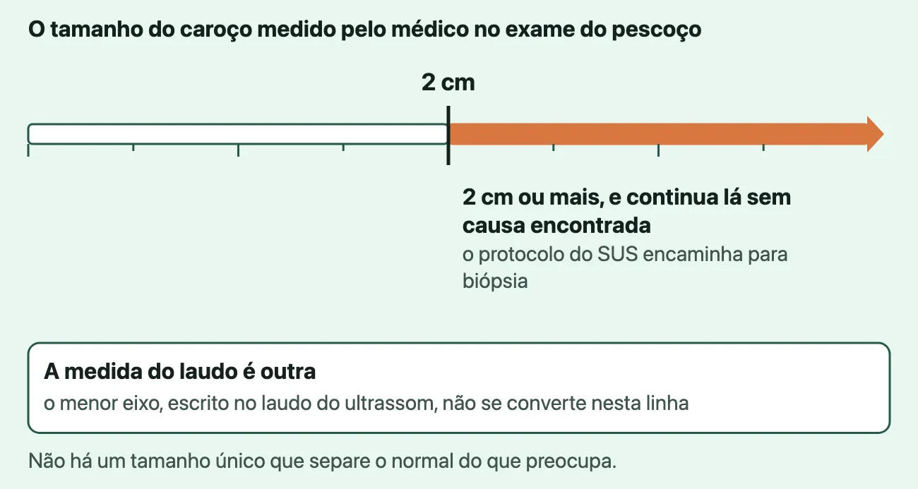 Uma régua de tamanhos sem números, com uma marca em 2 cm, que mede o caroço apalpado pelo médico no exame do pescoço; dali em diante a régua fica laranja: 2 cm ou mais, se o caroço continua lá sem causa encontrada, o protocolo do SUS encaminha para biópsia. Num quadro abaixo: a medida do menor eixo, escrita no laudo do ultrassom, é outra e não se converte nesta linha.