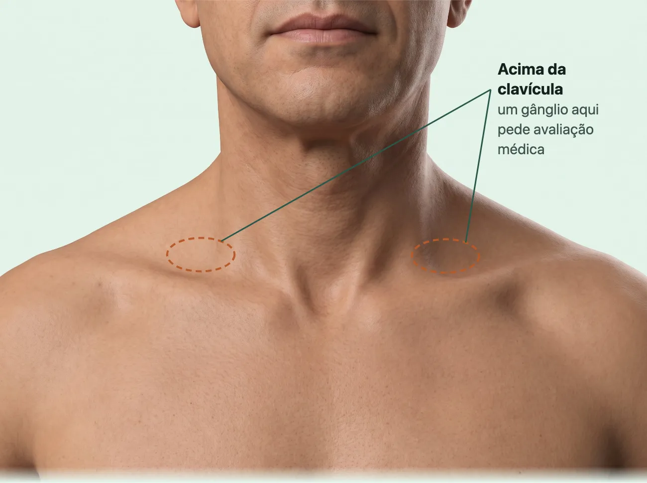 O pescoço e o alto do peito de um homem, de frente, com a região logo acima de cada clavícula contornada dos dois lados e um rótulo: um gânglio que aparece ali pede avaliação médica.