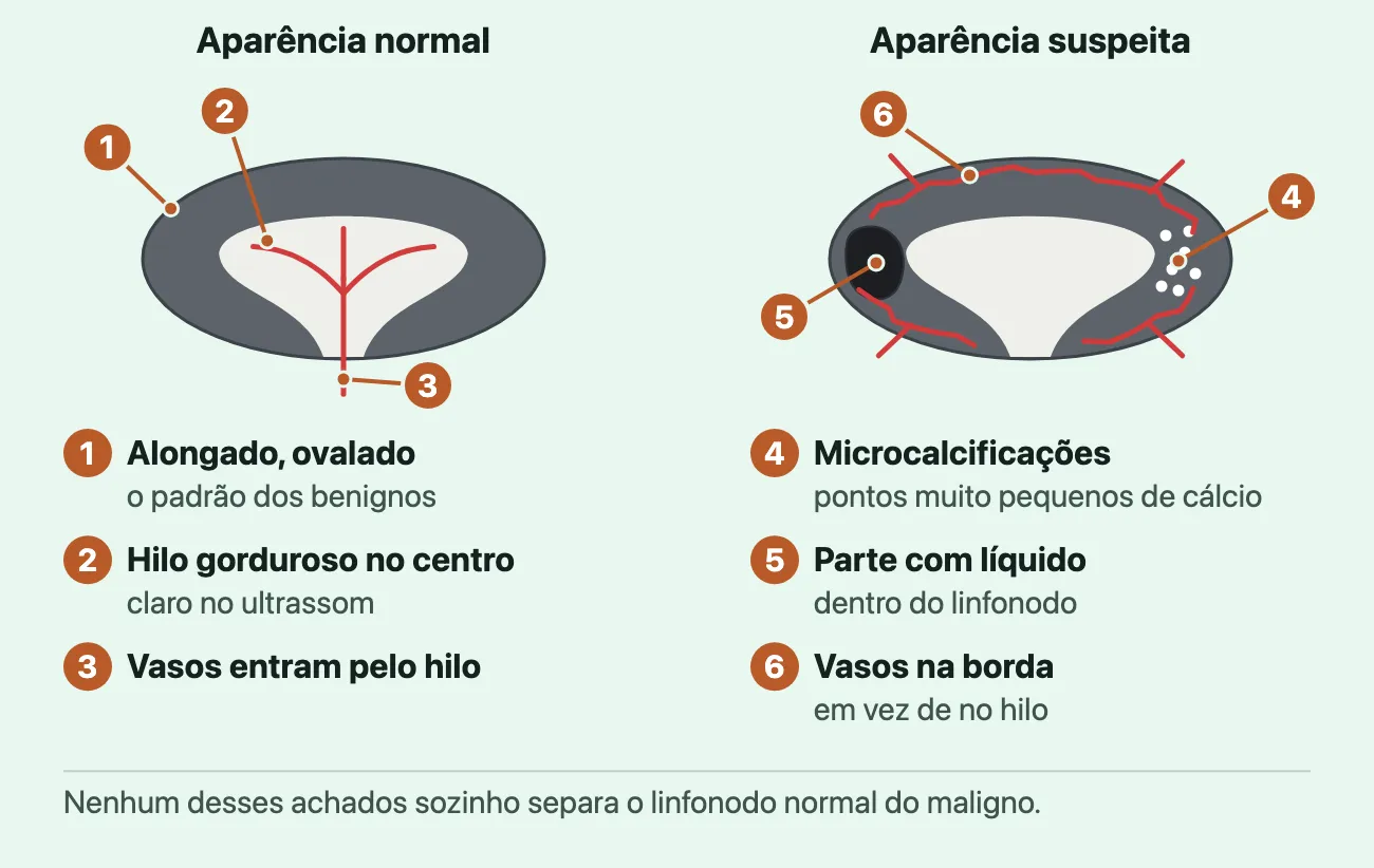 Dois desenhos de linfonodo, com a mesma forma e o mesmo tamanho: alongados e ovalados, cinza-escuros na borda, com o hilo gorduroso claro no centro. O de "aparência normal" tem vasos vermelhos que entram pelo hilo. O de "aparência suspeita" tem pontinhos brancos de microcalcificação, uma mancha preta de uma parte com líquido e vasos vermelhos pela borda, nenhum no hilo.