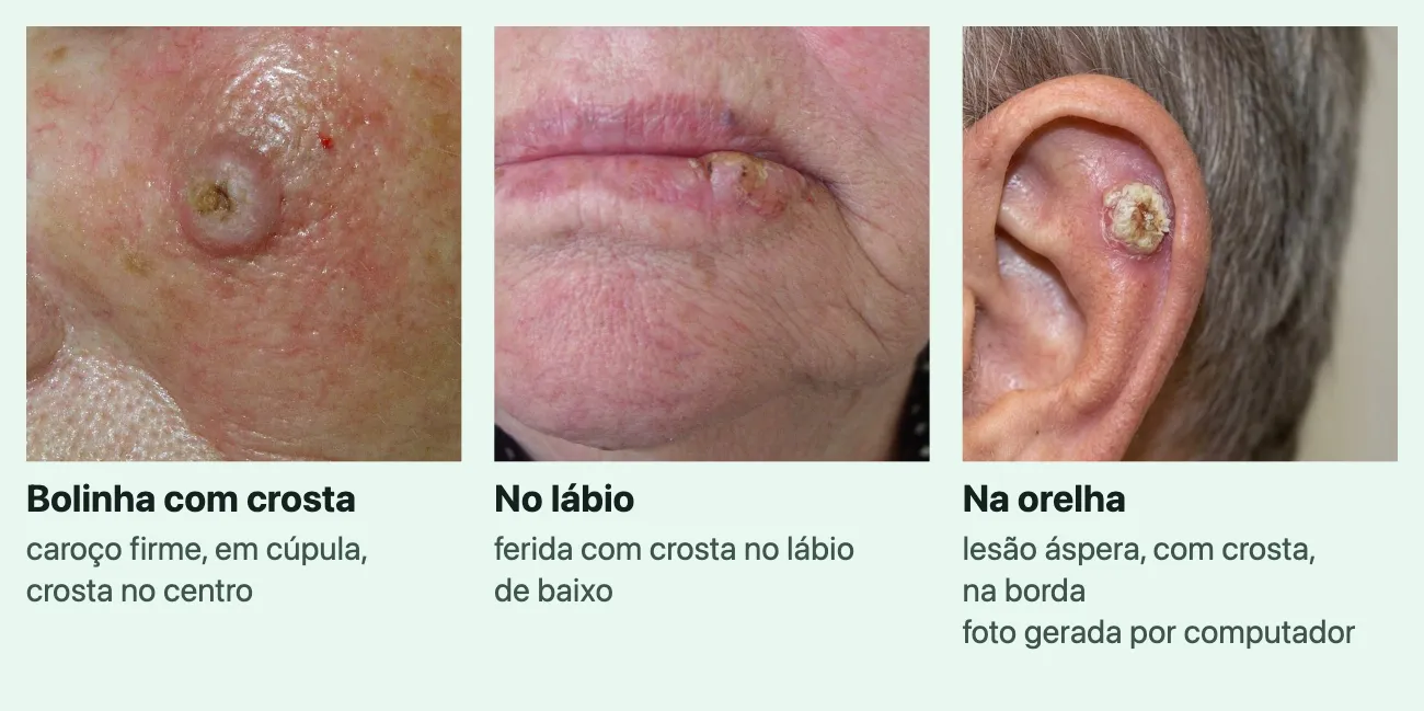 Três fotos do carcinoma espinocelular, cada uma com o nome e uma linha. "Bolinha com crosta", "caroço firme, em cúpula, crosta no centro": um caroço rosado e redondo, com uma crosta amarelada no meio, na pele avermelhada do rosto. "No lábio", "ferida com crosta no lábio de baixo": uma crosta amarelada perto do canto do lábio de baixo. "Na orelha", "lesão áspera, com crosta, na borda", marcada "foto gerada por computador": uma lesão redonda, com crosta esbranquiçada, na borda de cima da orelha, com cabelo grisalho atrás.
