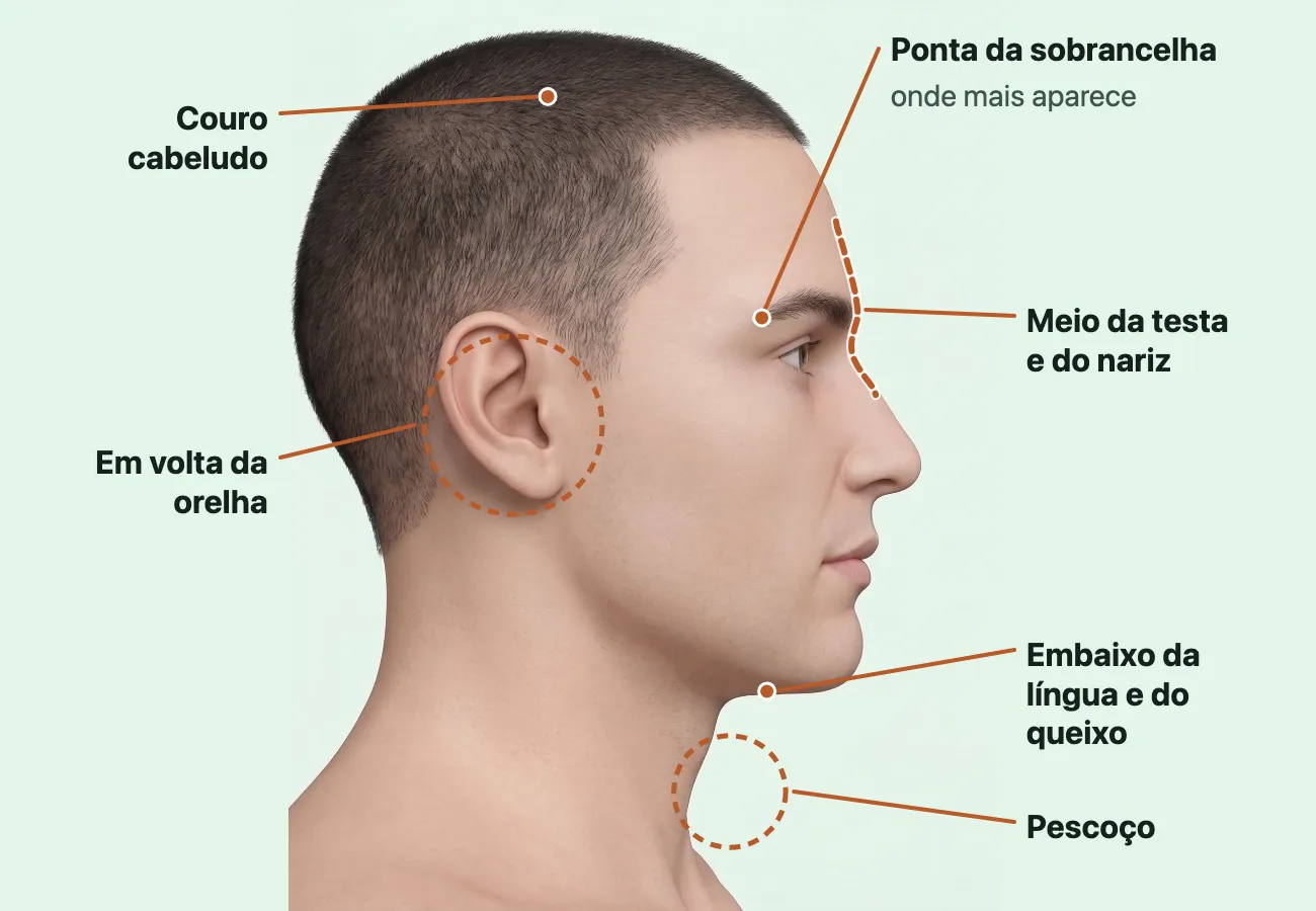 Desenho da cabeça e do pescoço de um adulto de perfil, com seis lugares marcados e nomeados: a ponta de fora da sobrancelha, onde o cisto dermoide mais aparece; o meio da testa e do nariz; o couro cabeludo; em volta da orelha; embaixo do queixo, onde fica também o que aparece embaixo da língua; e a frente do pescoço.