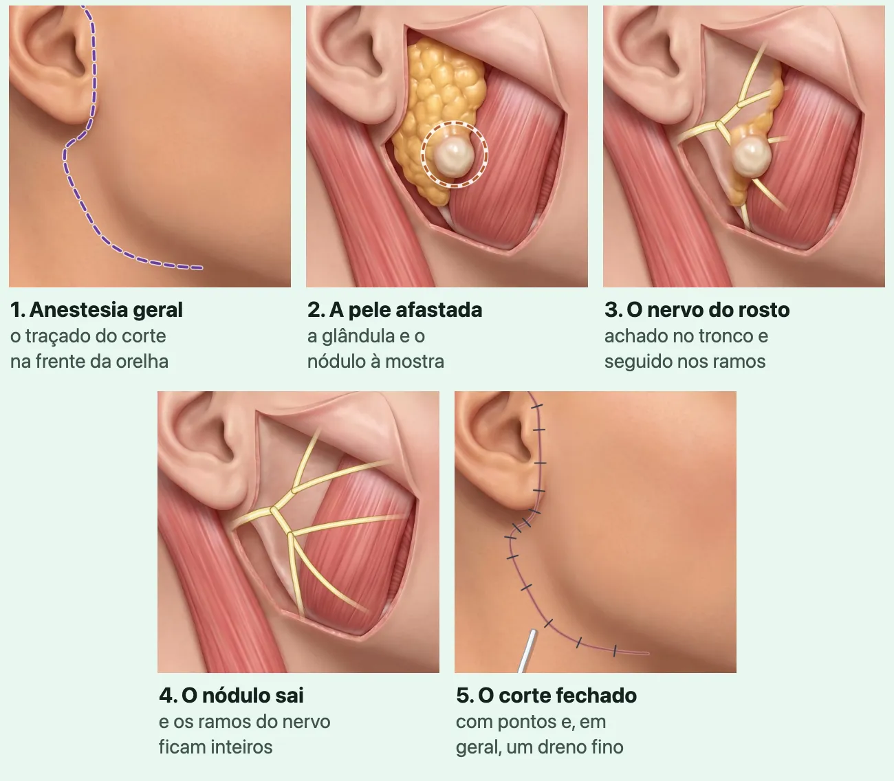 Cinco ilustrações do mesmo lado do rosto: o traçado do corte tracejado na frente da orelha, descendo para o pescoço; a pele afastada com a glândula amarela e um nódulo claro; o nervo do rosto, uma linha clara, achado no tronco e seguido nos ramos sob a glândula que resta; o leito sem a glândula com os ramos do nervo inteiros em leque; a pele fechada com pontos e um tubo fino saindo do pescoço.