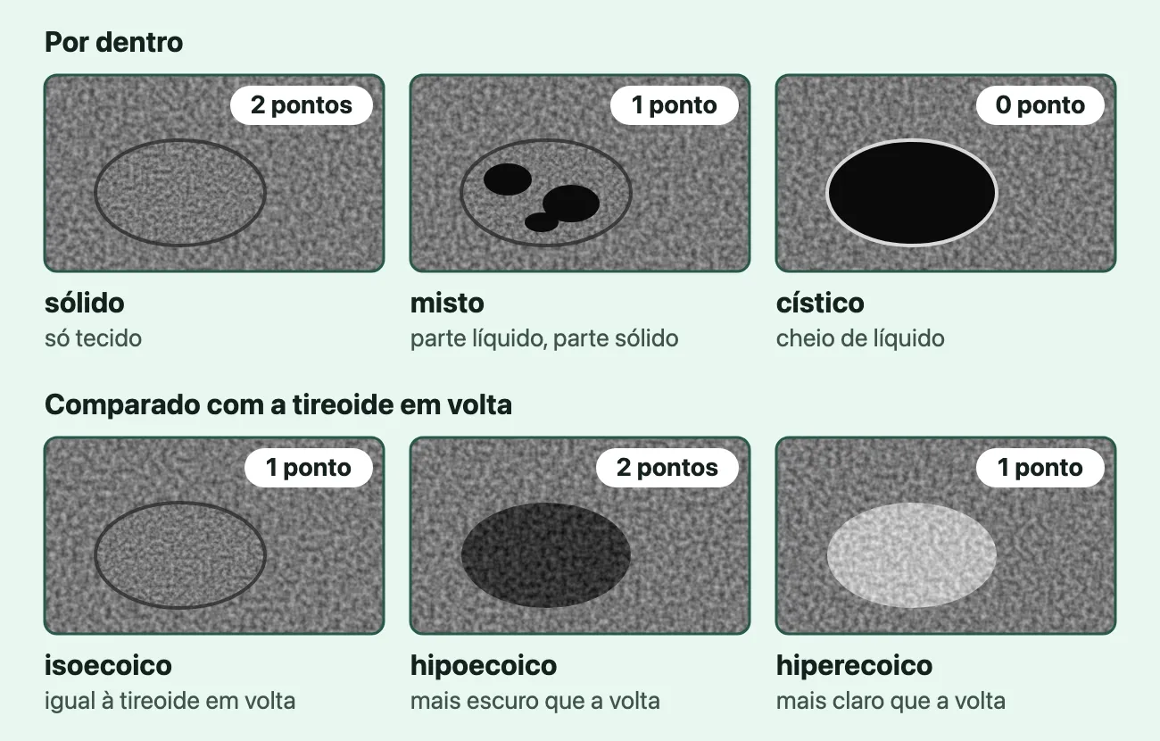 Seis quadros desenhados, cada um com um nódulo oval sobre uma textura cinza granulada, a palavra do laudo, uma linha do que ela quer dizer e os pontos num selo. "Por dentro": "sólido", "só tecido", 2 pontos, o nódulo com a mesma textura da volta; "misto", "parte líquido, parte sólido", 1 ponto, o nódulo com três manchas pretas; "cístico", "cheio de líquido", 0 ponto, o nódulo todo preto. "Comparado com a tireoide em volta": "isoecoico", "igual à tireoide em volta", 1 ponto, do mesmo cinza da volta; "hipoecoico", "mais escuro que a volta", 2 pontos; "hiperecoico", "mais claro que a volta", 1 ponto.