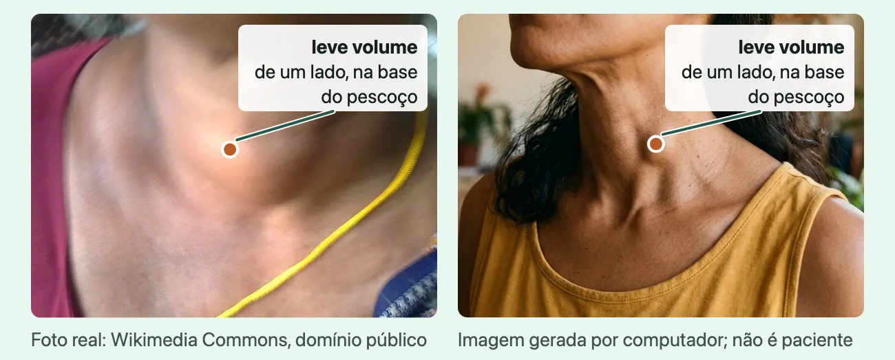 Duas fotos do pescoço de pessoas de tons de pele diferentes: à esquerda, foto real de uma mulher de pele negra com um volume arredondado de um lado, na parte baixa da frente do pescoço; à direita, imagem gerada de uma mulher de pele morena com um leve volume no lado esquerdo, na base do pescoço, abaixo do pomo de adão; um ponto marca o nódulo na tireoide em cada foto.