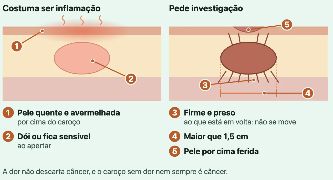 Dois desenhos das camadas do pescoço, com um caroço do mesmo tamanho sob a pele em cada um. Em "Costuma ser inflamação", a pele por cima avermelhada e quente, e o caroço que dói ou fica sensível ao apertar. Em "Pede investigação", o caroço escuro, firme, preso por traços às camadas em volta, com uma cota de "maior que 1,5 cm" e uma pequena ferida na pele por cima. Embaixo, a frase "A dor não descarta câncer, e o caroço sem dor nem sempre é câncer."