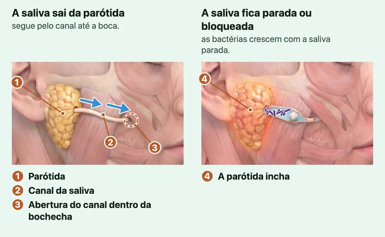 Dois desenhos da mesma cabeça de perfil, olhando para a direita, com a pele translúcida. No primeiro, a saliva sai da parótida, a glândula amarela na frente da orelha, e segue pelo canal até a boca, com setas azuis ao longo do canal; um anel marca a abertura do canal, dentro da bochecha. No segundo, uma pedra branca bloqueia o canal e a saliva fica parada atrás dela, com pequenos bastonetes roxos que representam as bactérias crescendo; a parótida está inchada e avermelhada.