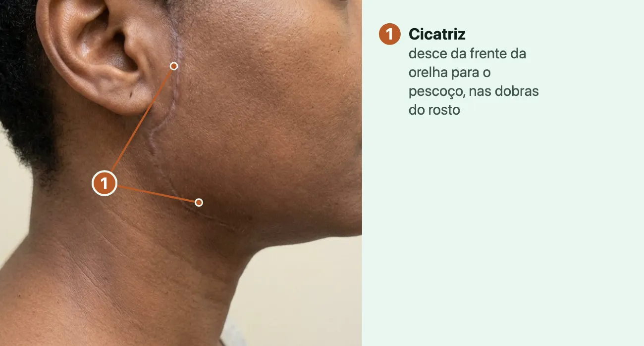 Foto do lado do rosto e do pescoço de uma mulher, de perfil, com uma cicatriz fina e clara que desce da frente da orelha até o pescoço, abaixo da mandíbula.