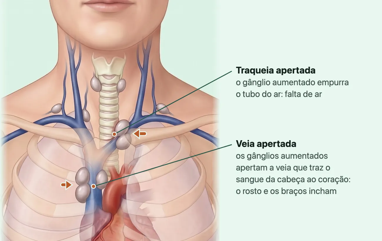 Ilustração do pescoço e do alto do peito de frente, com a traqueia no meio, a veia azul que desce até o coração e gânglios aumentados acinzentados encostados nas duas; setas mostram um gânglio empurrando a traqueia e outros apertando a veia.