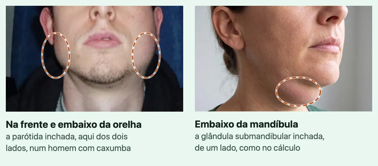 À esquerda, foto da parte de baixo do rosto de um homem com caxumba, com as bochechas e a mandíbula inchadas na frente e embaixo das duas orelhas, contornadas. À direita, imagem gerada do lado do rosto e do pescoço de uma mulher, com um inchaço arredondado contornado embaixo da mandíbula, entre o ângulo e o queixo.