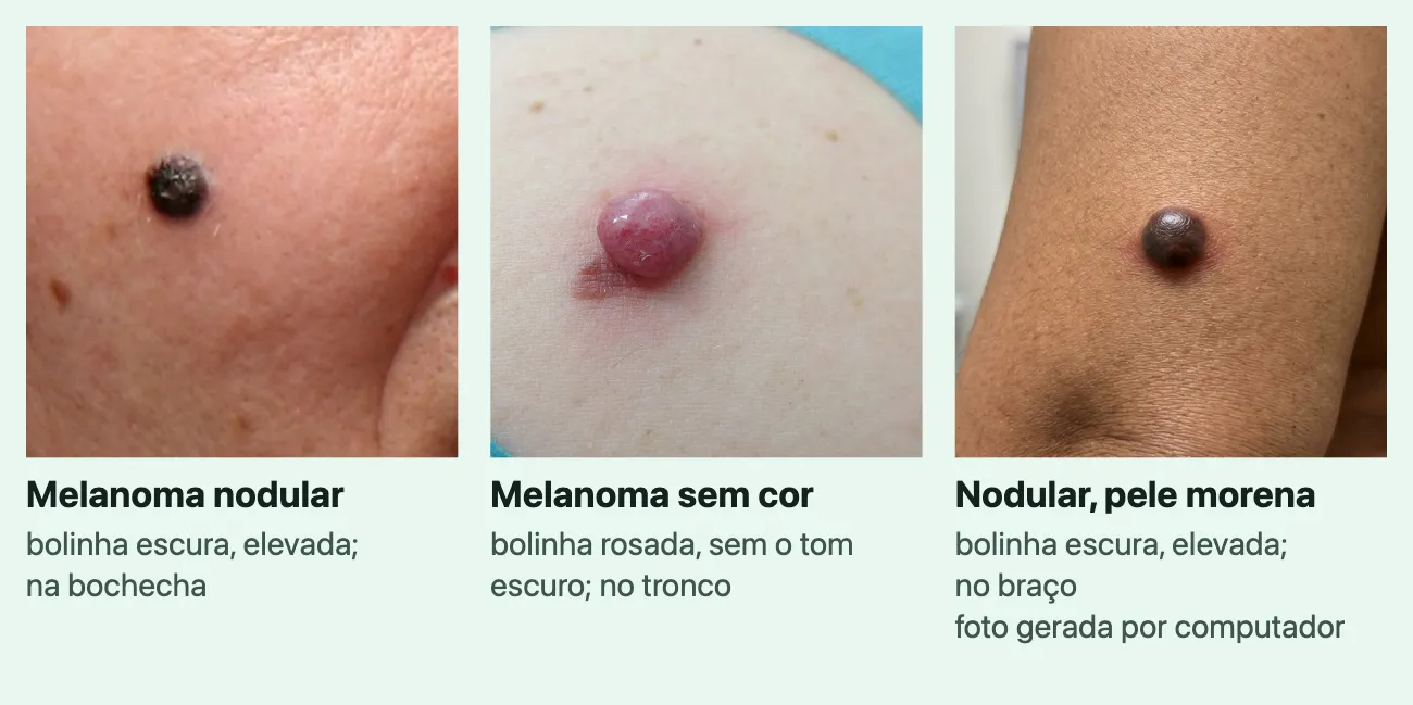 Três fotos de melanoma, cada uma com o nome e uma linha. "Melanoma nodular", "bolinha escura, elevada; na bochecha": uma bolinha preta e redonda na pele clara do rosto, perto da orelha. "Melanoma sem cor", "bolinha rosada, sem o tom escuro; no tronco": uma bolinha rosada e brilhante, com uma pequena área avermelhada na base. "Nodular, pele morena", "bolinha escura, elevada; no braço", marcada "foto gerada por computador": uma bolinha escura e lisa na pele morena do braço, perto do cotovelo.