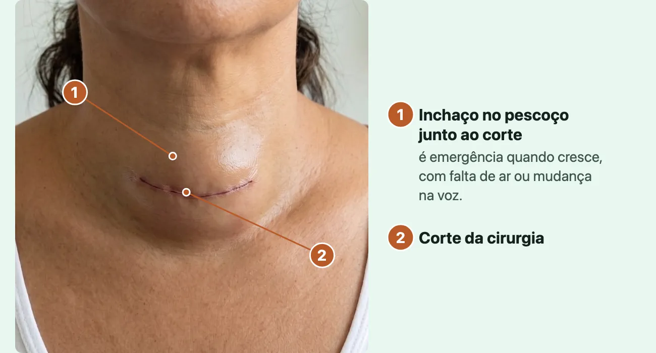 Foto de frente do pescoço de uma mulher, do queixo às clavículas: um corte curto, fino e fechado numa dobra da parte baixa da frente do pescoço, e em volta e acima dele a frente do pescoço estufada, lisa e esticada.