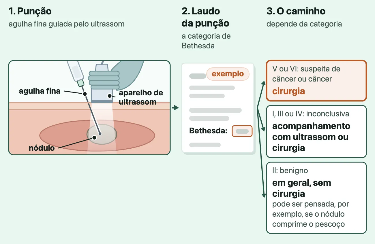 Três passos desenhados. 1, punção: corte da frente do pescoço com a tireoide e um nódulo; uma mão enluvada segura o aparelho de ultrassom sobre a pele, em cima do nódulo, e uma agulha fina entra ao lado dele com a ponta dentro do nódulo. 2, laudo da punção: folha de exemplo com a categoria de Bethesda marcada. 3, os caminhos: V ou VI, cirurgia; I, III ou IV, acompanhamento com ultrassom ou cirurgia; II, em geral sem cirurgia.