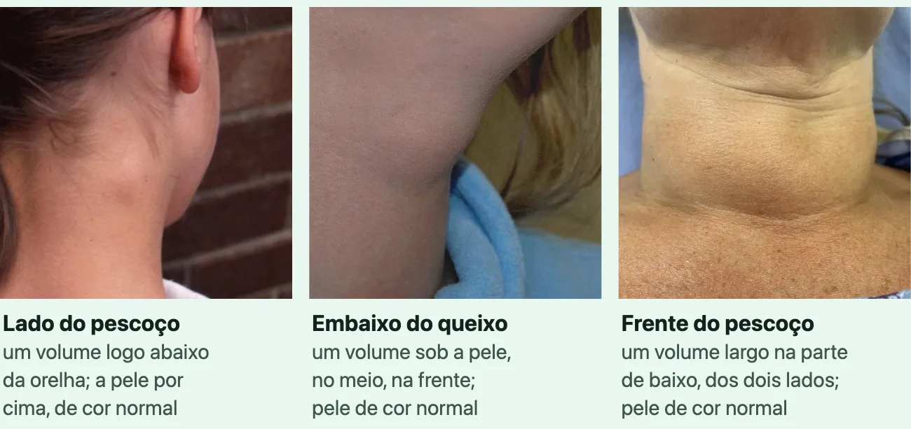 Três fotos reais de pescoços com um caroço visível, sem os olhos, cada uma com o lugar e o que se vê. "Lado do pescoço", "um volume logo abaixo da orelha; a pele por cima, de cor normal": a cabeça de uma pessoa de cabelo preso, fotografada por trás, e um volume no lado do pescoço, abaixo da orelha. "Embaixo do queixo", "um volume sob a pele, no meio, na frente; pele de cor normal": a parte de baixo do queixo e o alto do pescoço, vistos de lado, com a cabeça erguida, e um volume no meio da frente do pescoço, logo abaixo do queixo. "Frente do pescoço", "um volume largo na parte de baixo, dos dois lados; pele de cor normal": a frente do pescoço com um volume largo na metade de baixo, que ocupa os dois lados.