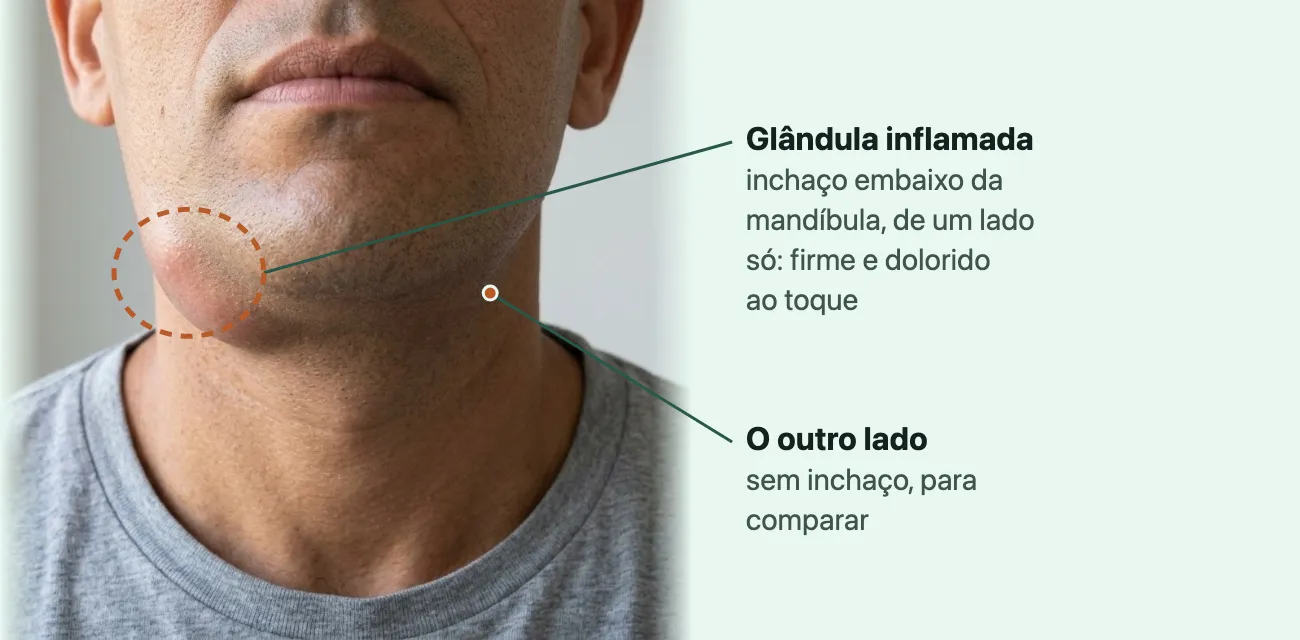 Imagem gerada da parte de baixo do rosto e do pescoço de um homem, de frente, com um inchaço arredondado contornado embaixo da mandíbula, de um lado só, e o outro lado sem inchaço.