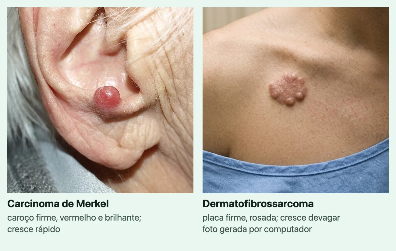 Duas fotos de tipos raros, cada uma com o nome e uma linha. "Carcinoma de Merkel", "caroço firme, vermelho e brilhante; cresce rápido": um caroço vermelho, liso e brilhante na orelha de uma pessoa de cabelo branco. "Dermatofibrossarcoma", "placa firme, rosada; cresce devagar", marcada "foto gerada por computador": uma placa rosada e elevada, com várias saliências arredondadas, no alto do peito, perto do ombro, acima da gola de uma blusa azul.