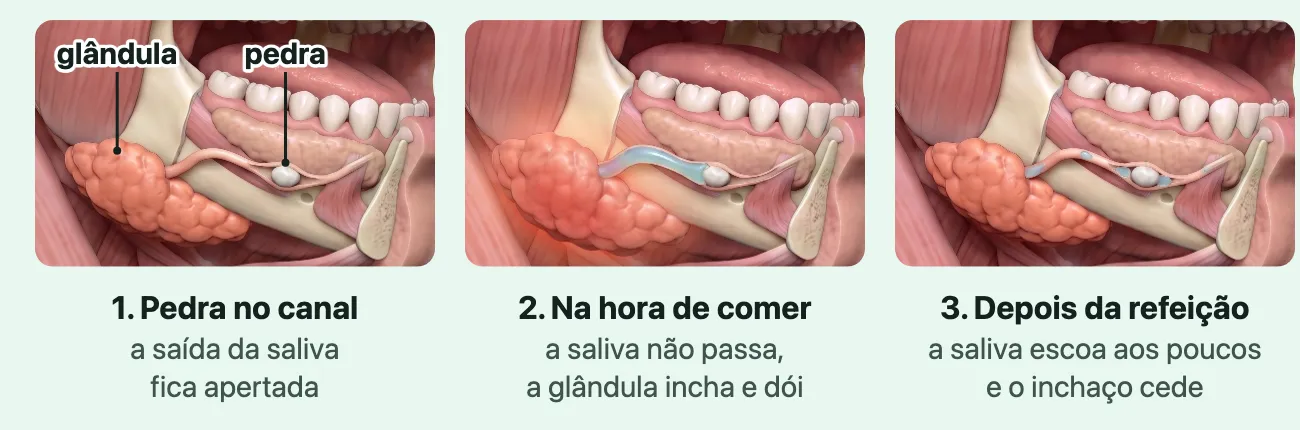 Três ilustrações do lado da cabeça com o chão da boca à vista: uma pedra branca dentro do canal que sai da glândula submandibular; na hora de comer, o canal cheio de saliva até a pedra e a glândula inchada; depois, gotas de saliva passando pela pedra e a glândula de volta ao tamanho.