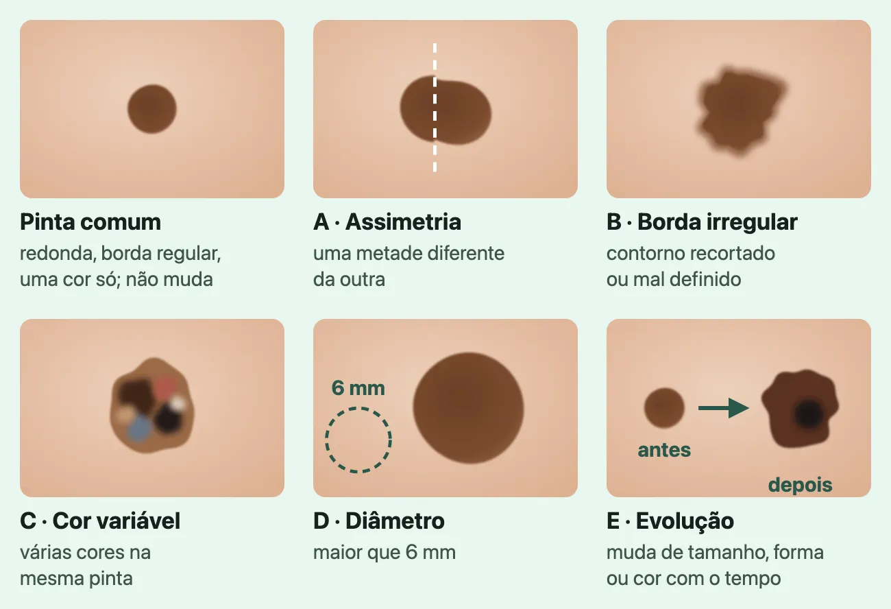 Desenho de seis retalhos de pele, cada um com uma pinta, um nome e uma linha. "Pinta comum", "redonda, borda regular, uma cor só; não muda": uma pinta pequena, redonda e marrom. "A · Assimetria", "uma metade diferente da outra": uma pinta cortada por uma linha tracejada, com as duas metades de formas diferentes. "B · Borda irregular", "contorno recortado ou mal definido": uma pinta de contorno recortado e borrado. "C · Cor variável", "várias cores na mesma pinta": uma pinta com marrom, preto, avermelhado, azul-acinzentado e um ponto claro. "D · Diâmetro", "maior que 6 mm": uma pinta grande ao lado de um círculo tracejado menor, marcado "6 mm". "E · Evolução", "muda de tamanho, forma ou cor com o tempo": uma pinta pequena e redonda marcada "antes", uma seta, e uma pinta maior, irregular e mais escura marcada "depois".
